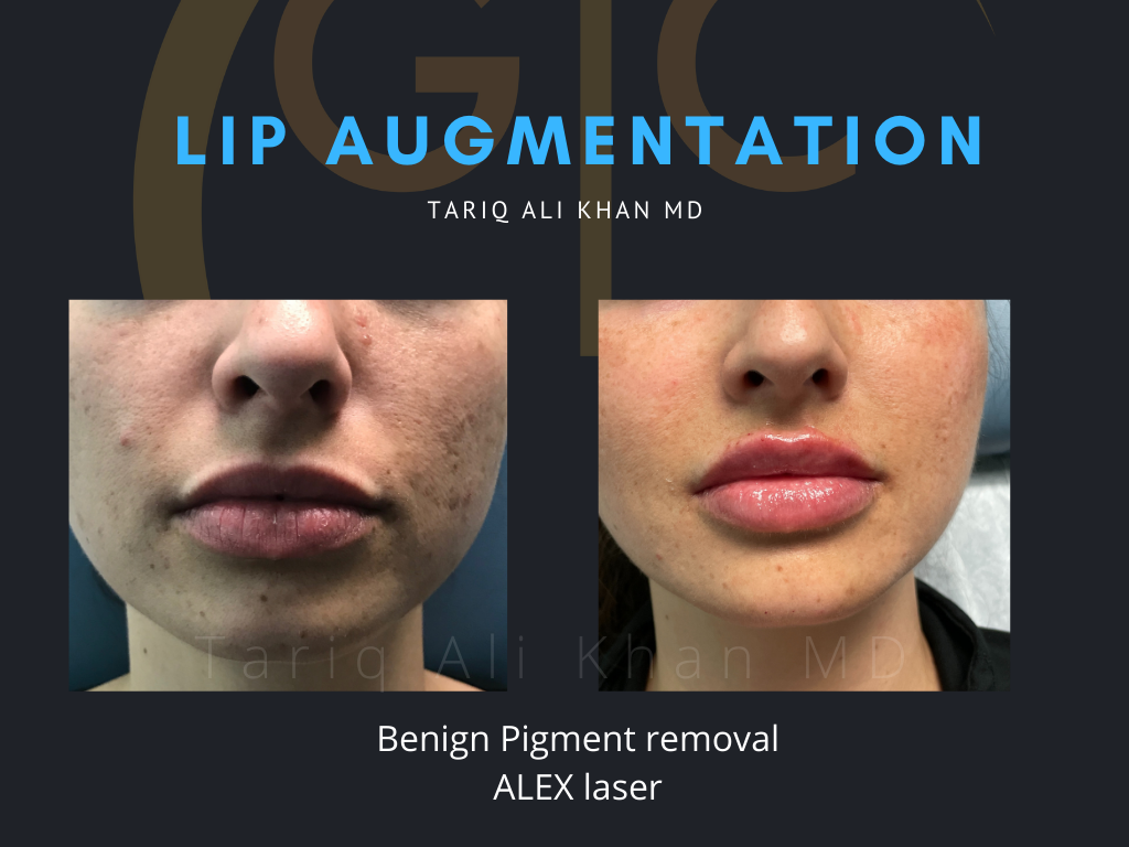 Gentle Care Laser Tustin Before and After picture - Lip Augmentation